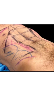 Liposuction