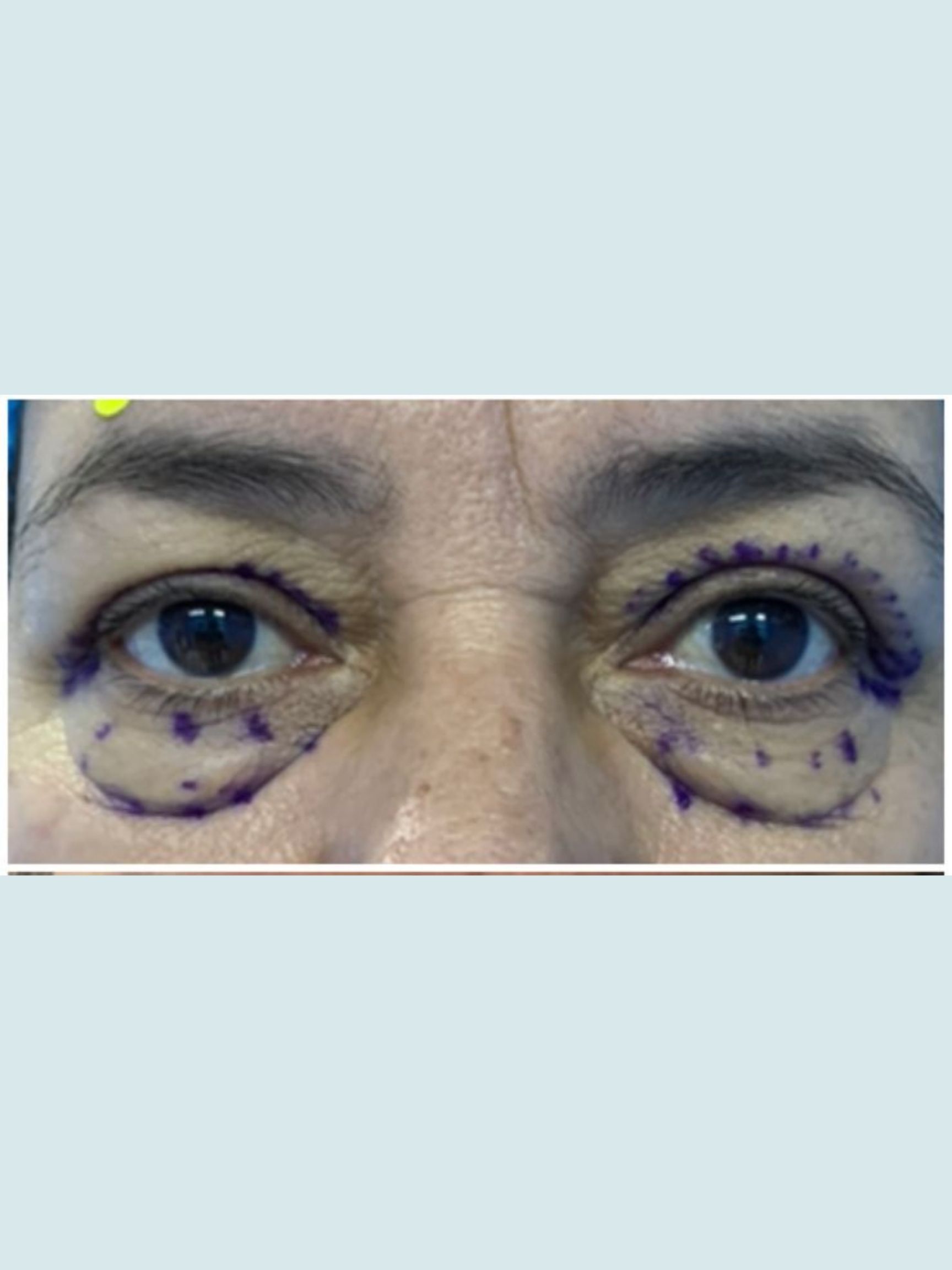 Eyelid Surgery