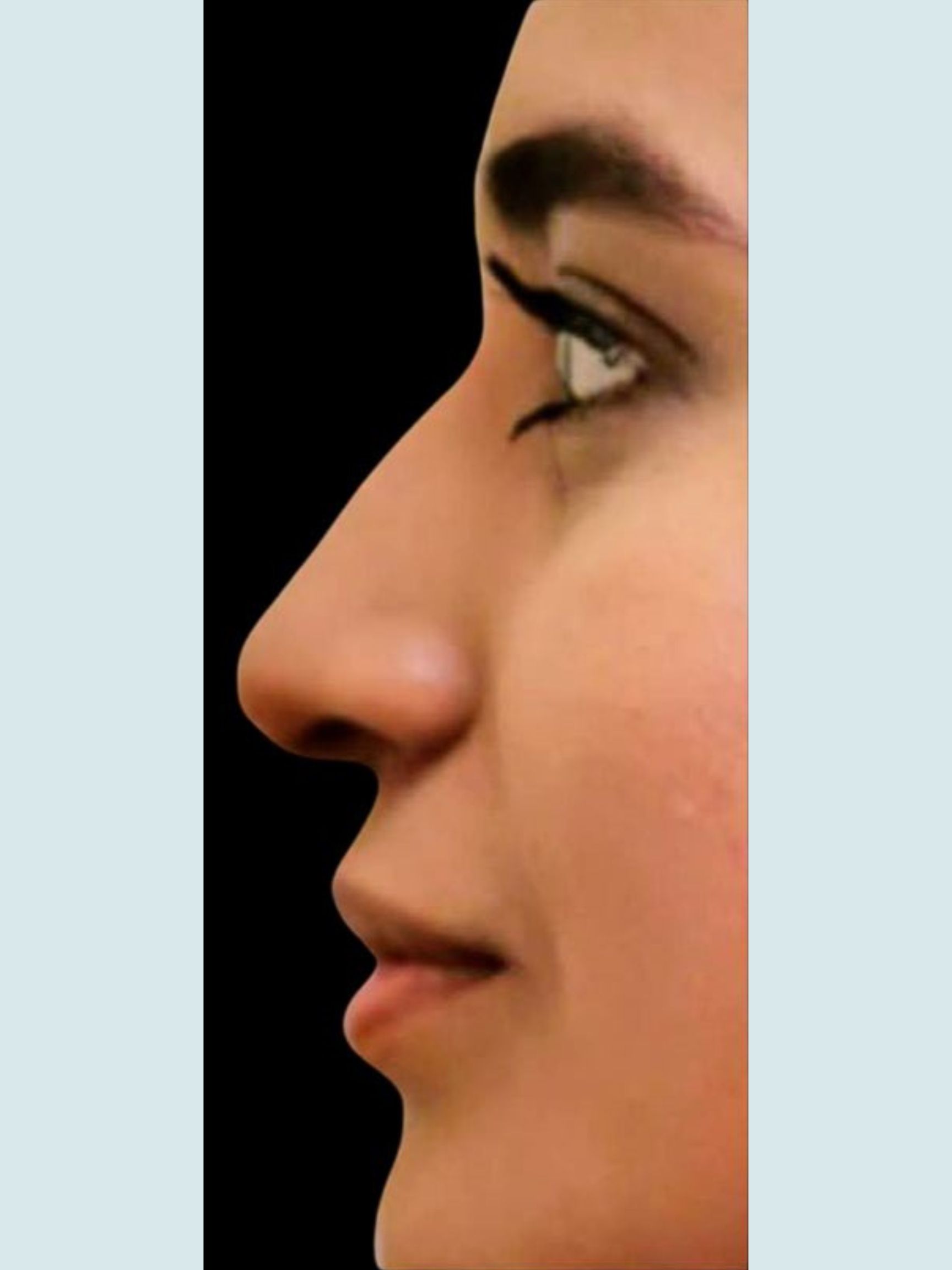 Rhinoplasty
