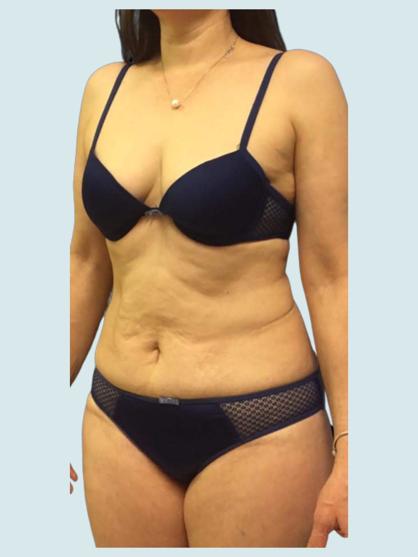 Tummy Tuck