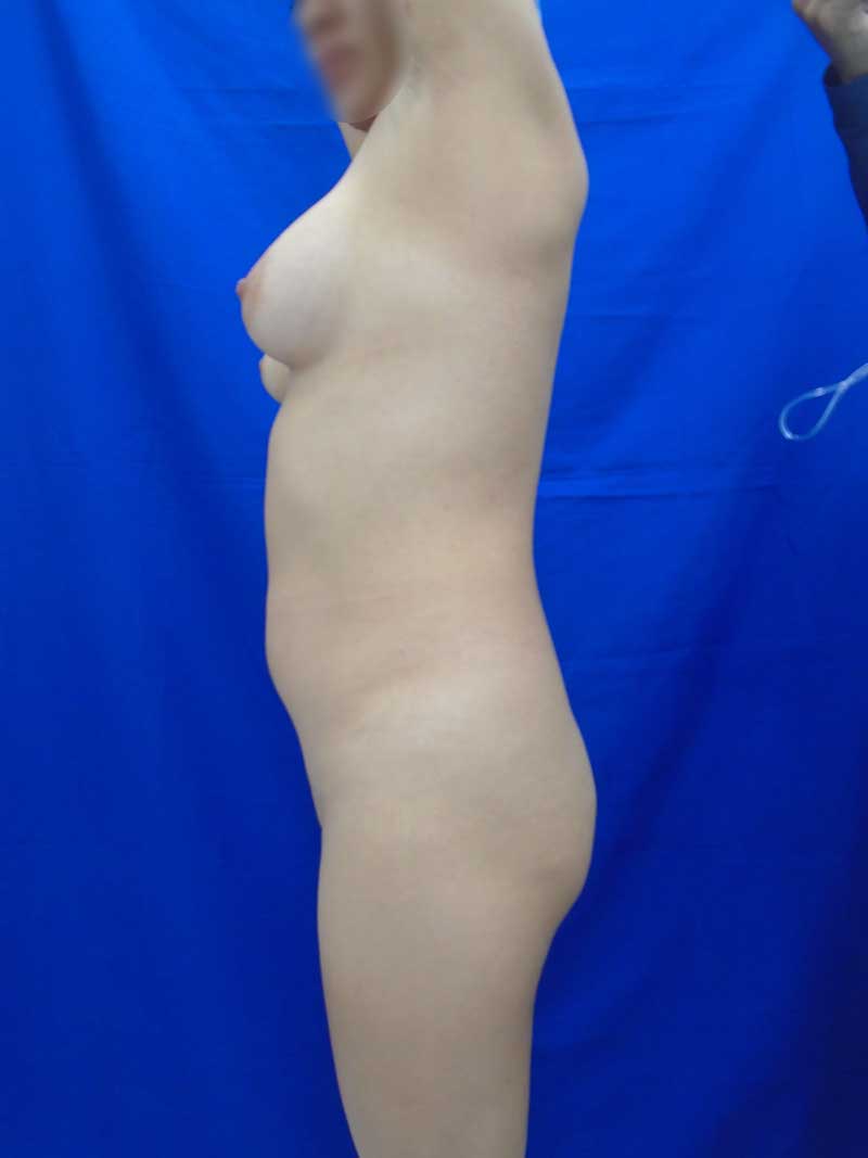 Liposuction