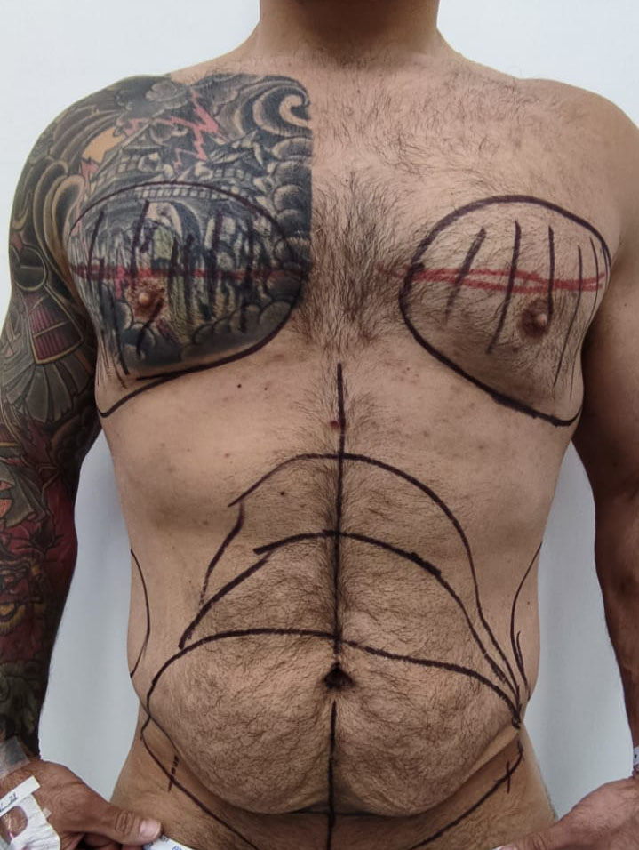 Tummy Tuck