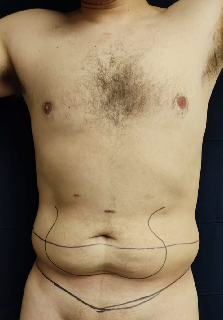 Tummy Tuck