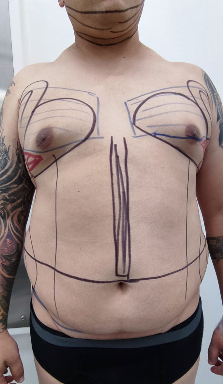 Tummy Tuck