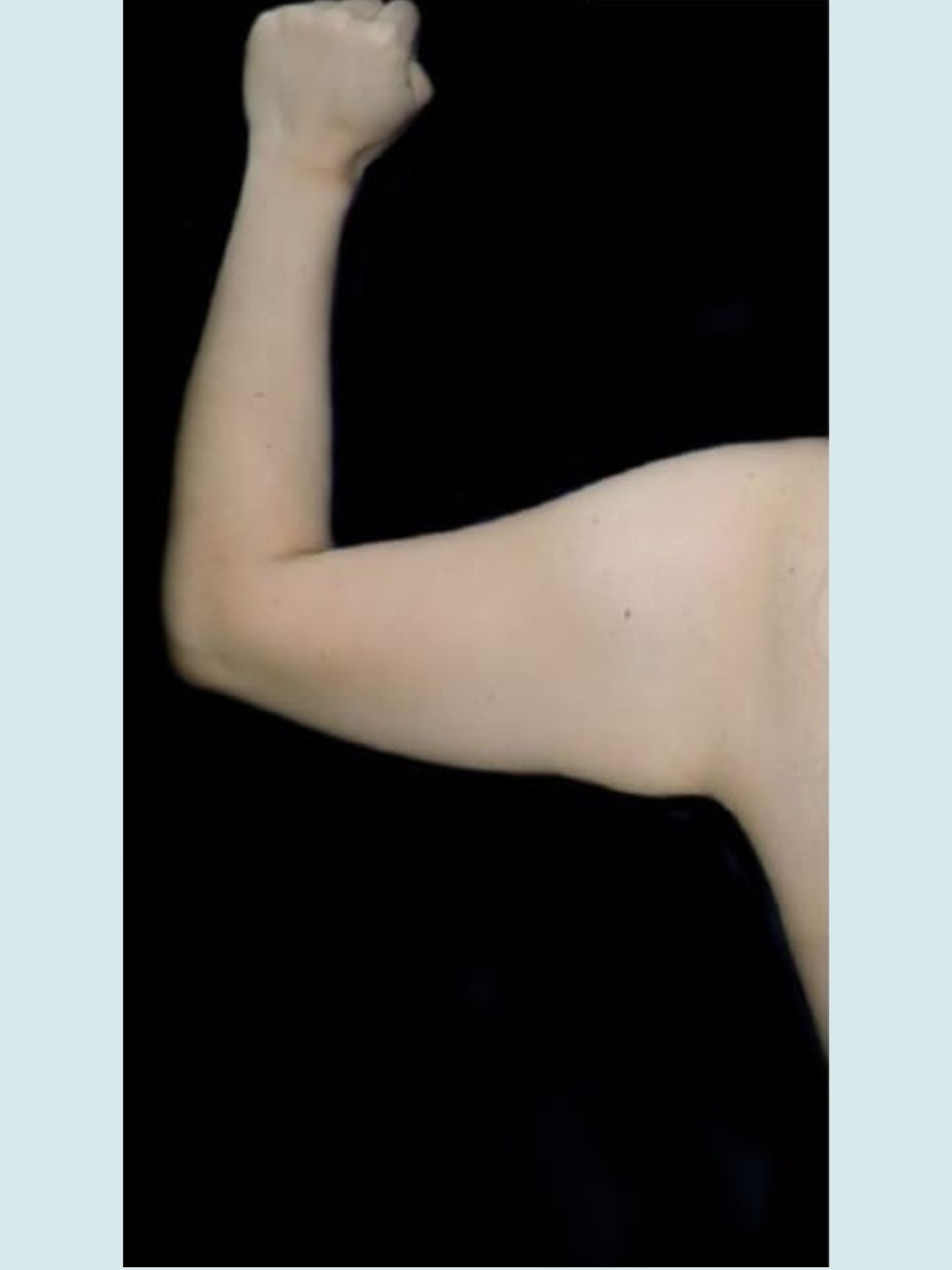 Arm Lift