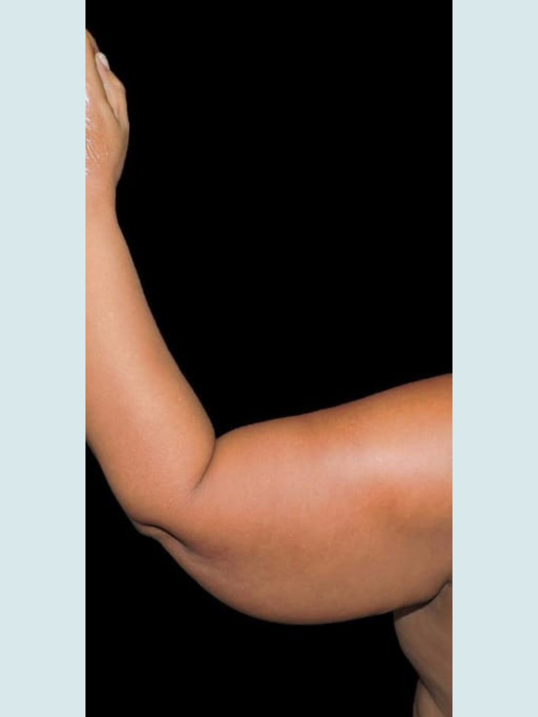 Arm Lift