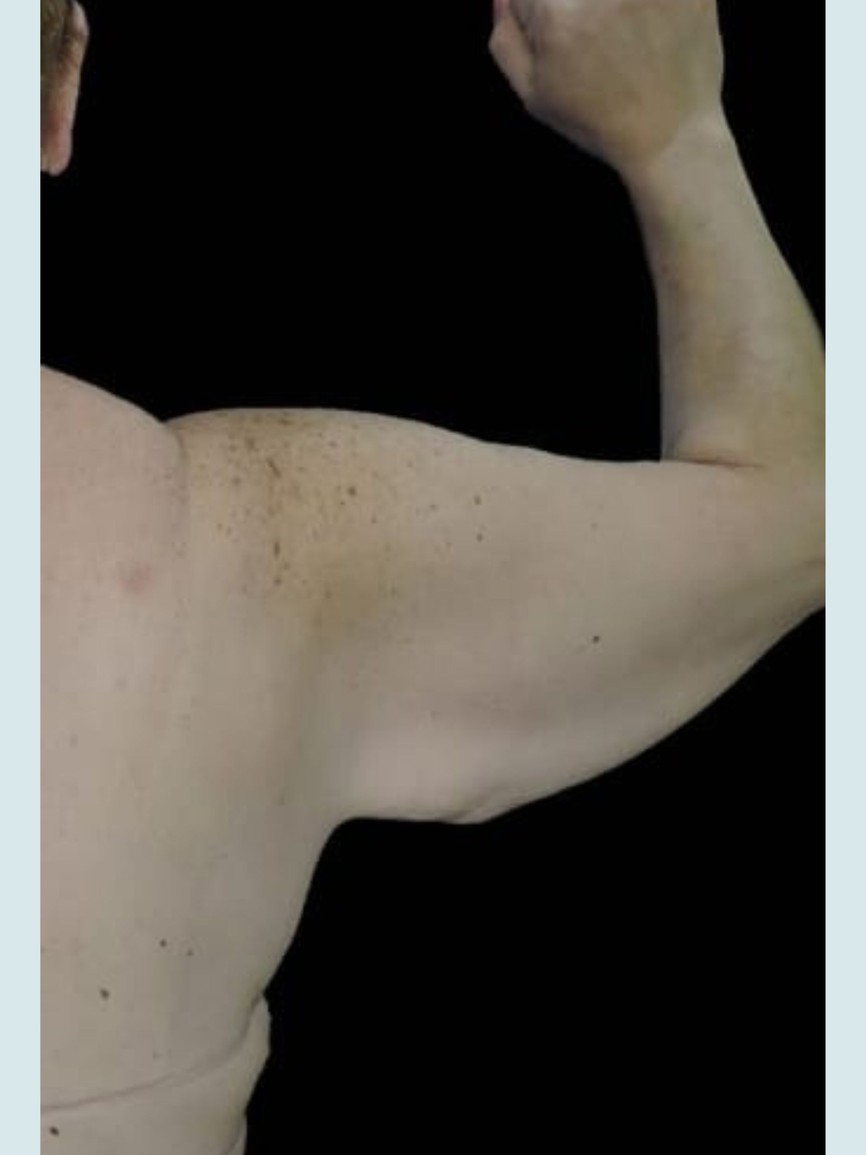 Arm Lift