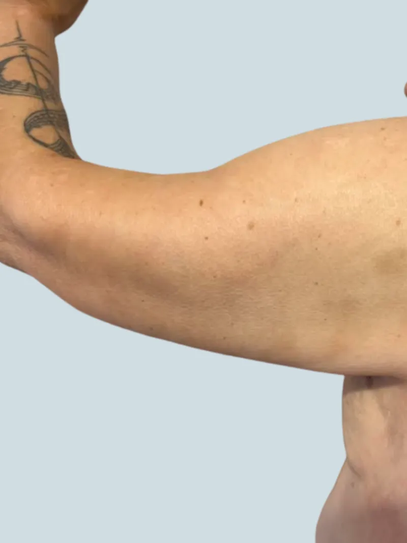 Arm Lift