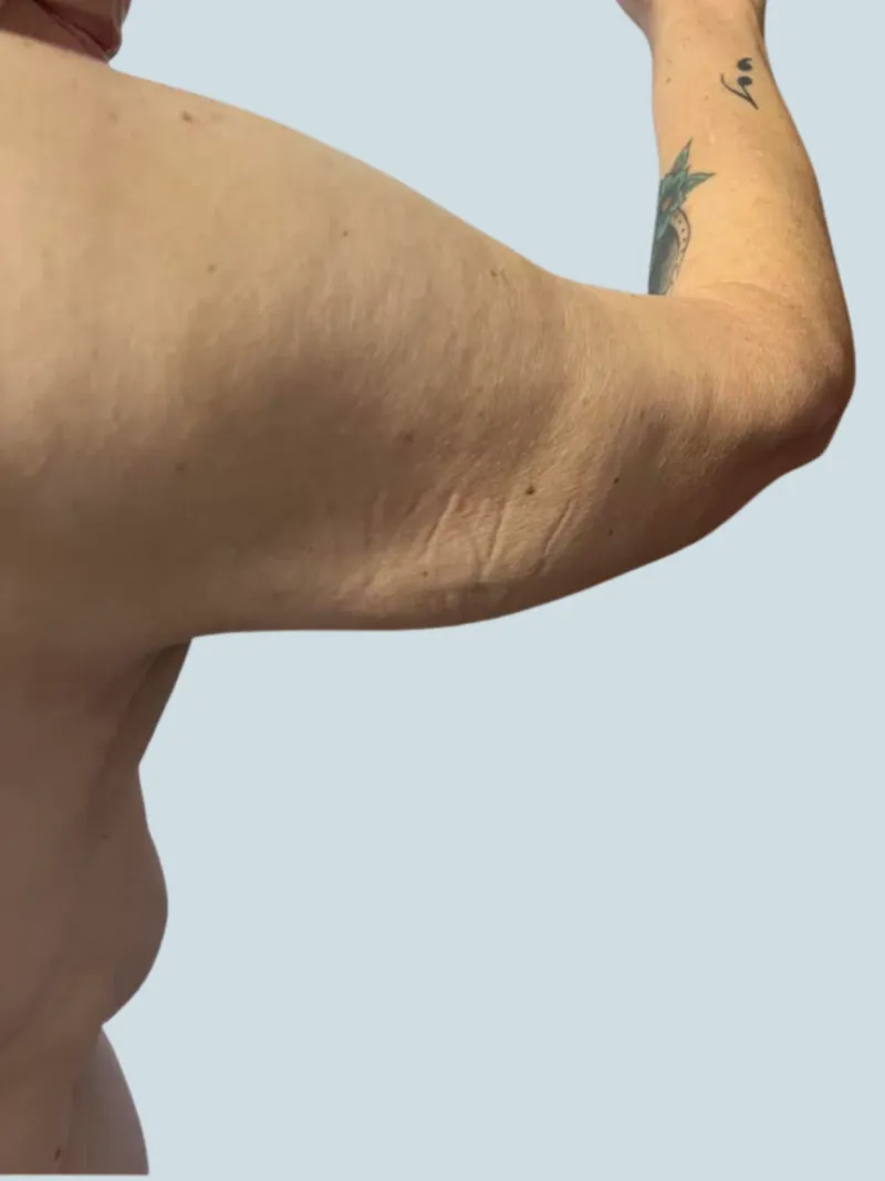 Arm Lift