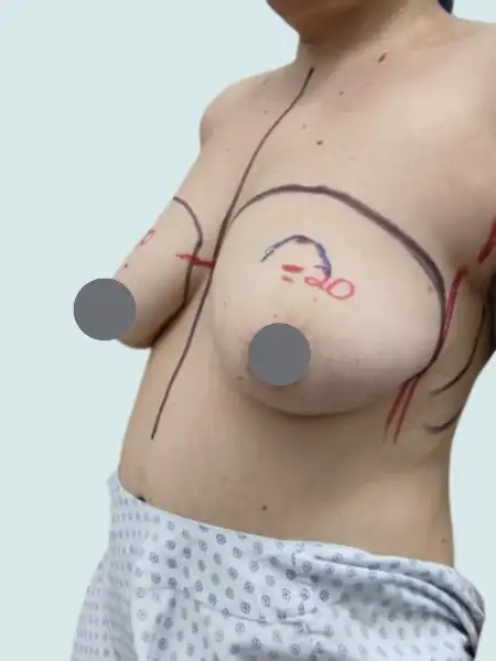 Breast Lift