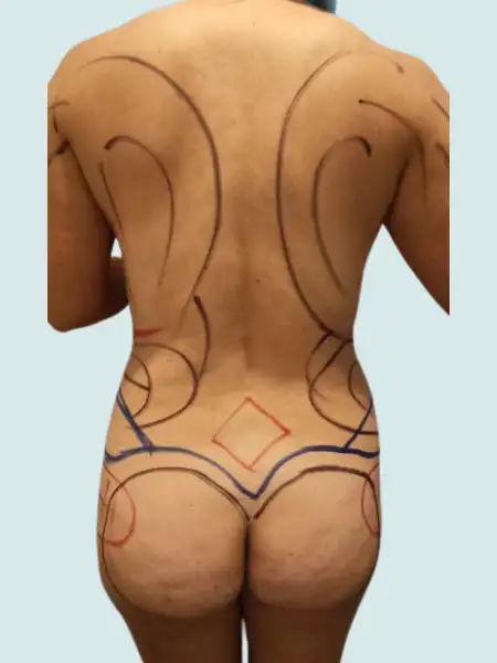 Extended Tummy Tuck with Lipo 360 and BBL and Breast Implants