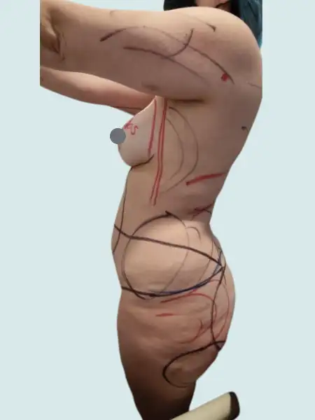 Extended Tummy Tuck with Lipo 360 and BBL and Breast Implants