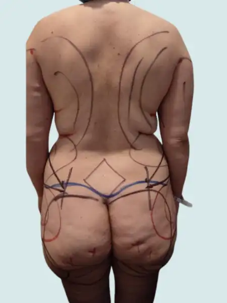 Extended Tummy Tuck with Lipo 360 and BBL and Breast Implants
