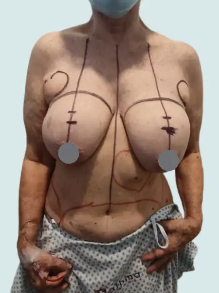 Implant Retirement Breast Lift with Fat Transfer