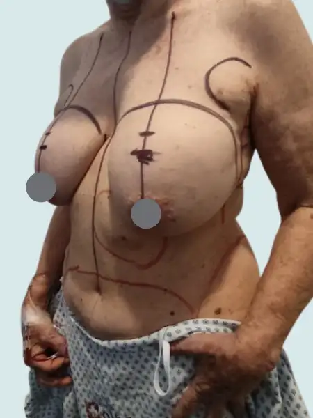 Implant Retirement Breast Lift with Fat Transfer
