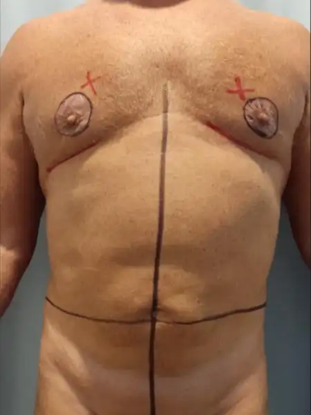 Male Circular Tummy Tuck with Lipo 360