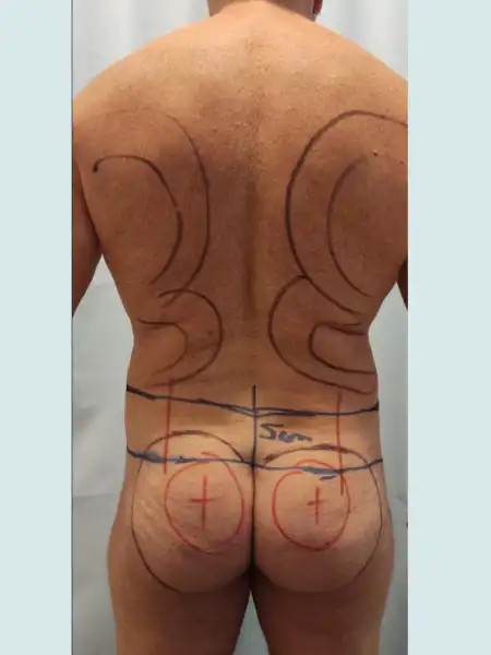 Male Circular Tummy Tuck with Lipo 360