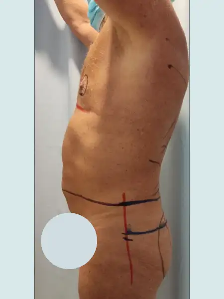 Male Circular Tummy Tuck with Lipo 360