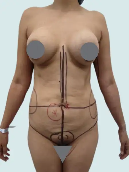 Tummy Tuck