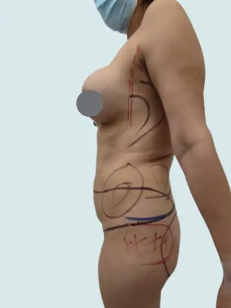 Tummy Tuck
