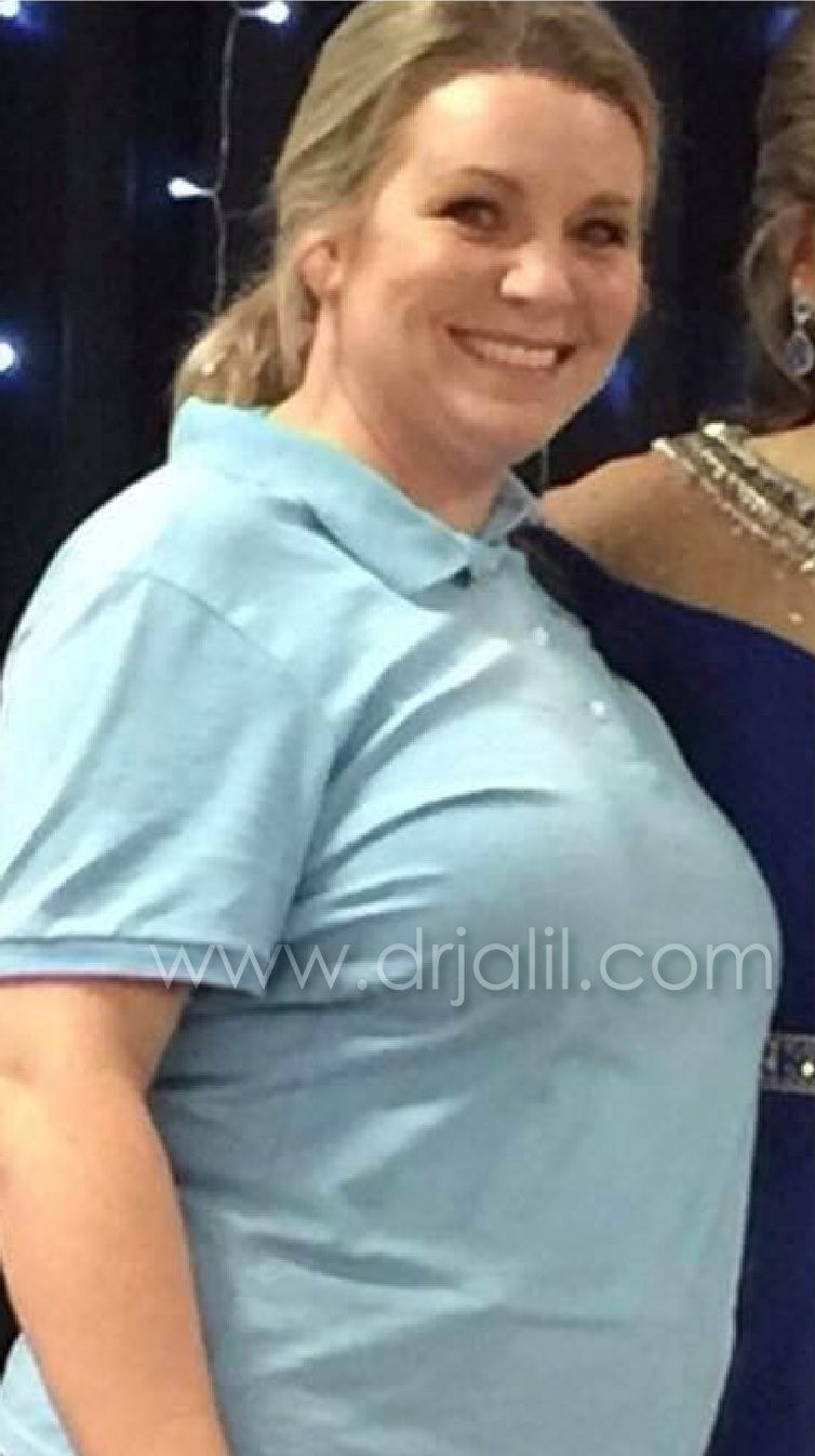 Weight-Loss Surgery