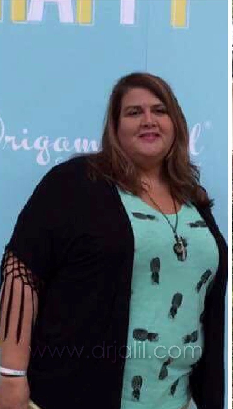 Weight-Loss Surgery
