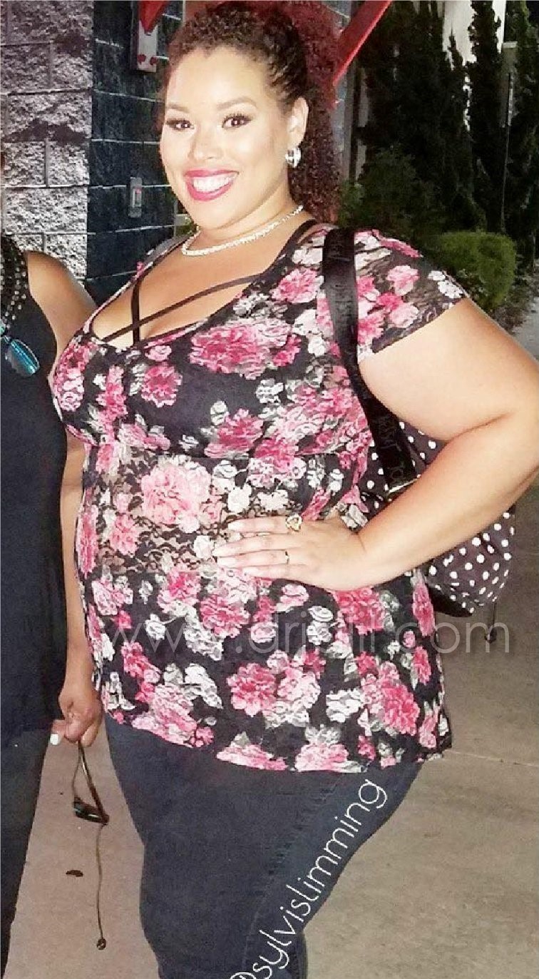 Weight-Loss Surgery