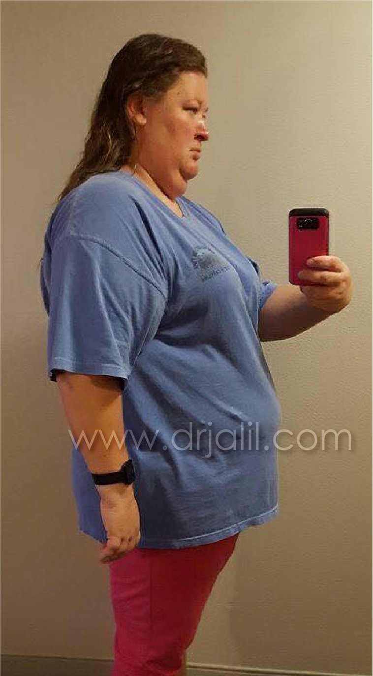 Weight-Loss Surgery