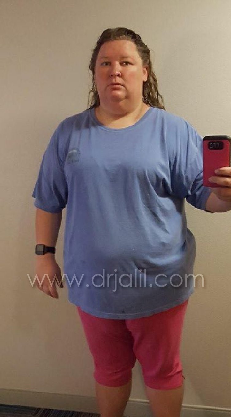 Weight-Loss Surgery