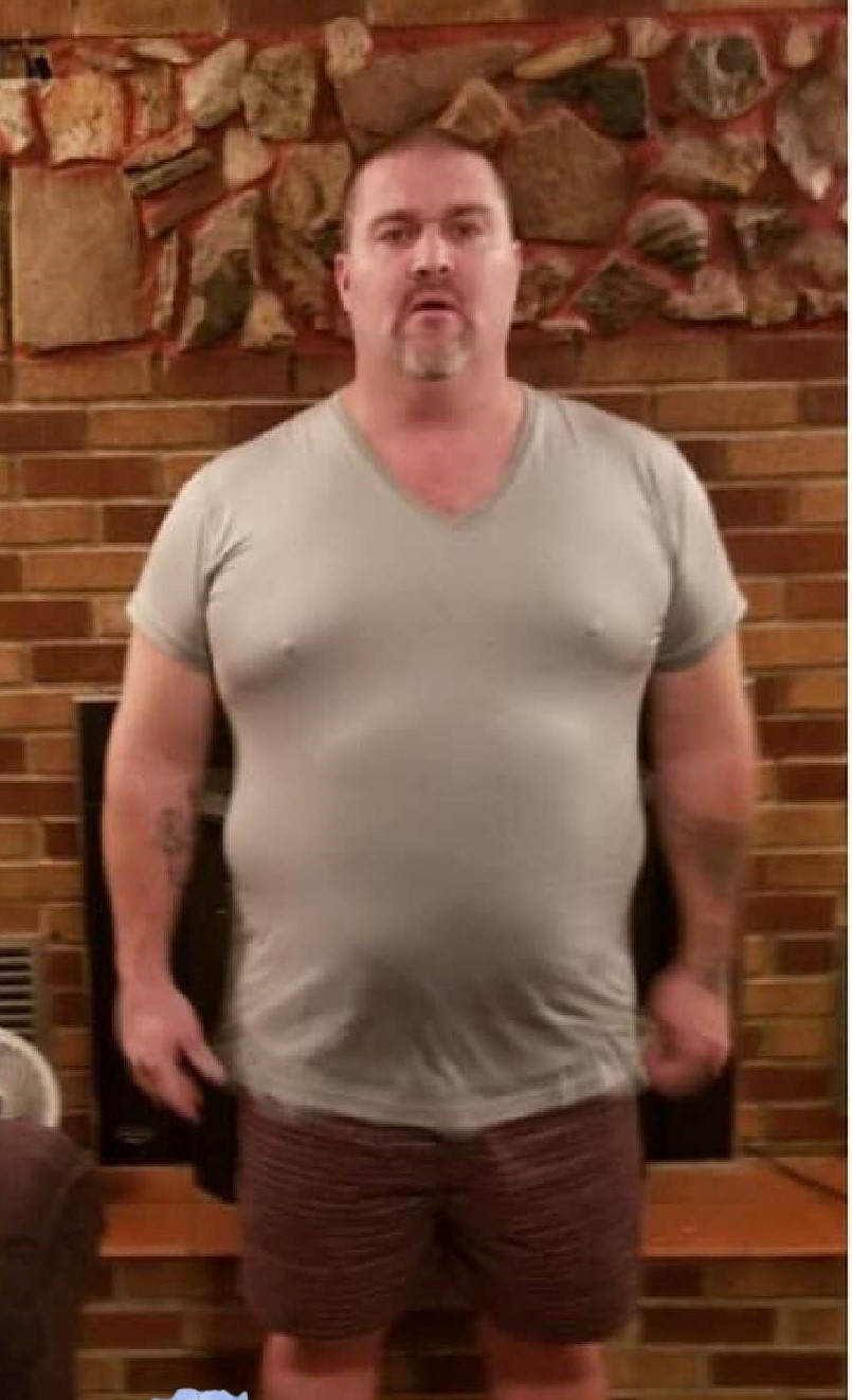Weight-Loss Surgery