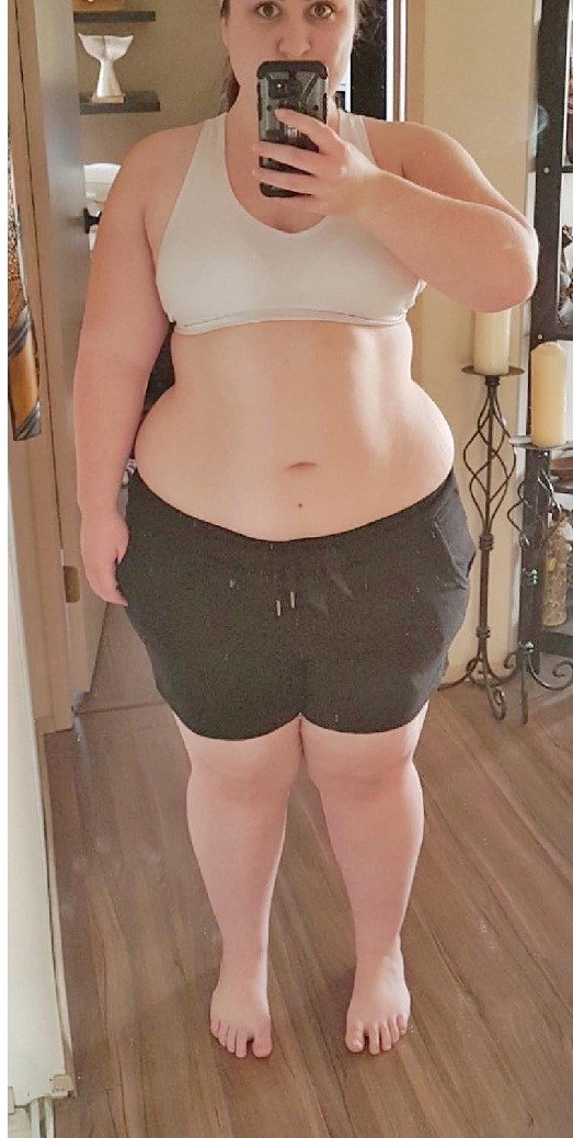 Weight-Loss Surgery