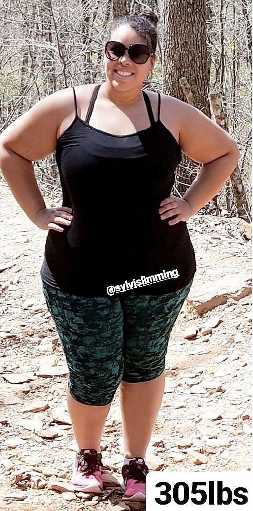 Weight-Loss Surgery