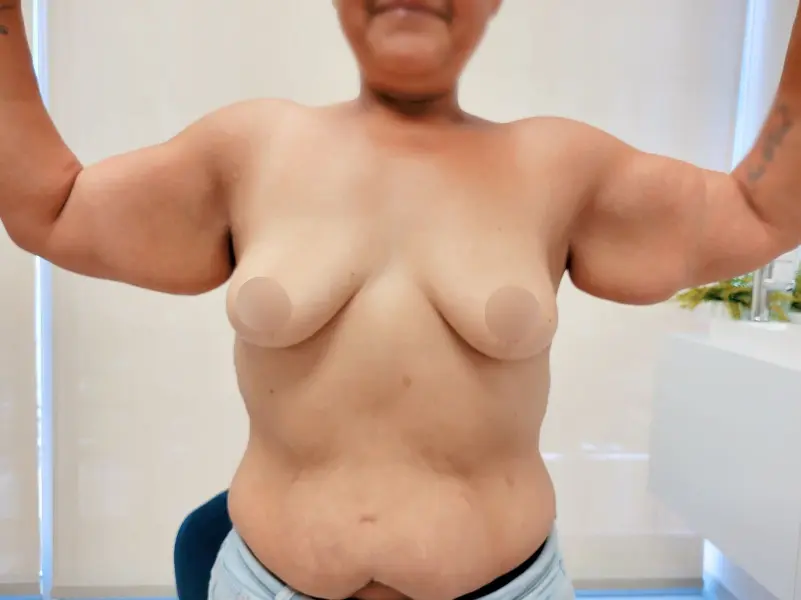 Arm Lift