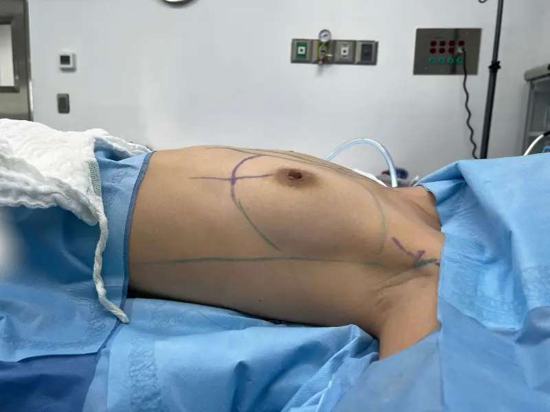 Breast Augmentation