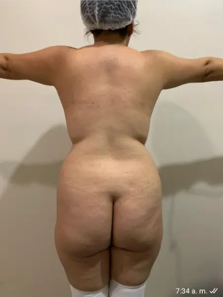 Lipo and BBL