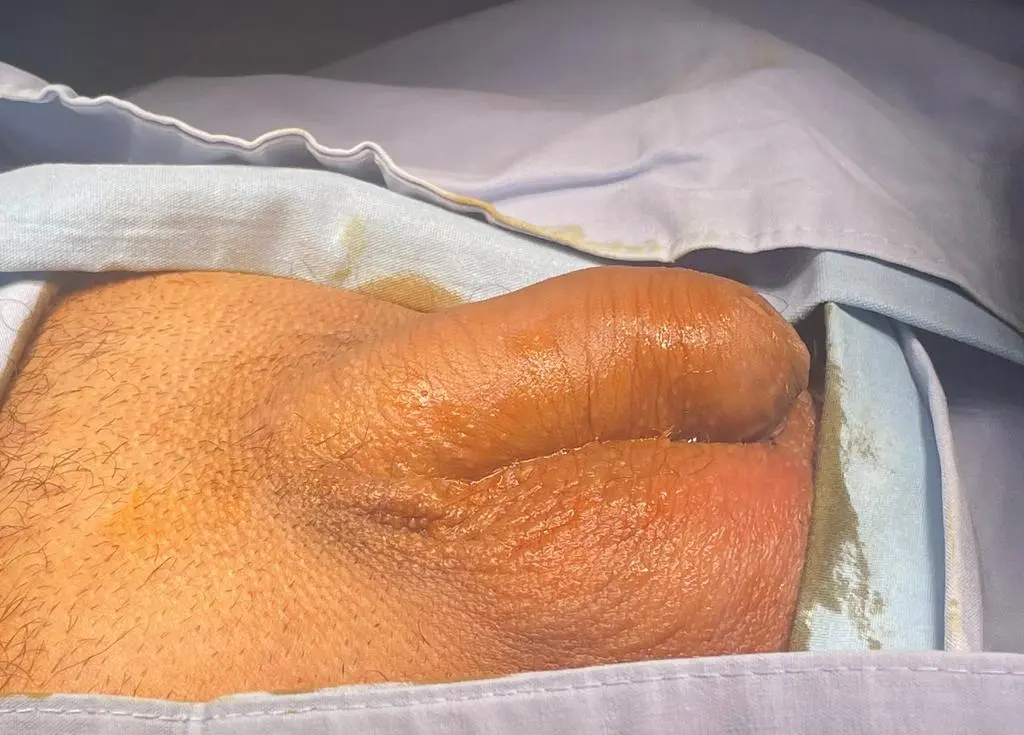Penis Enlargement