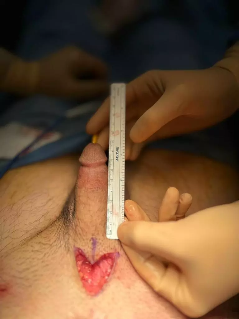 Penis Enlargement
