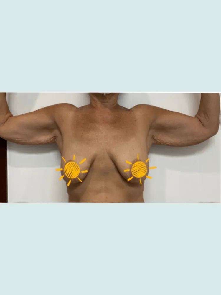 Breast Lift & Arm Lift 