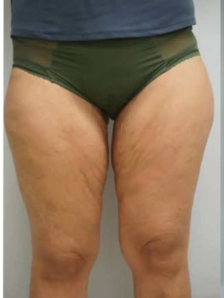 Thigh Lift