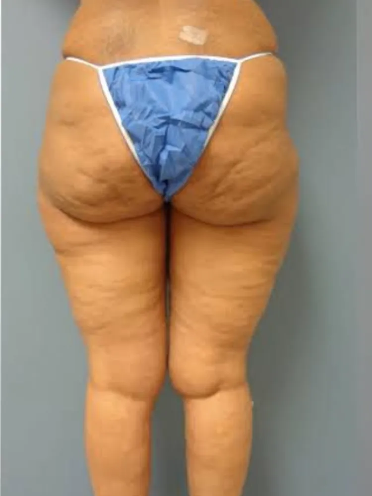 Thigh Lift