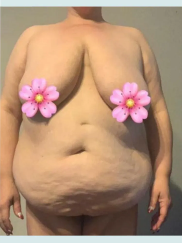 Tummy Tuck
